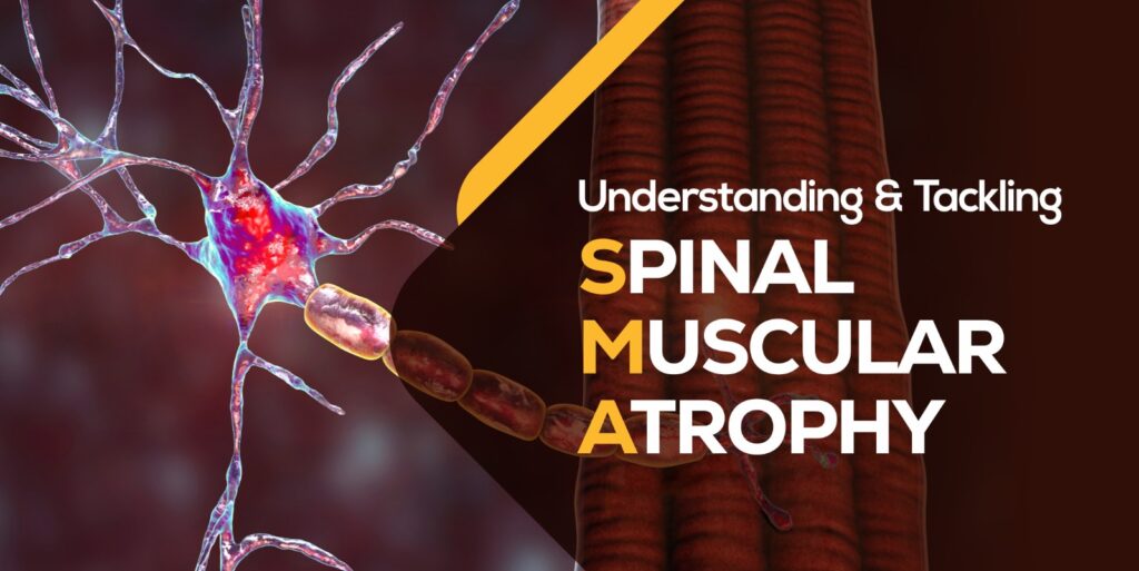 Understanding and Tackling Spinal Muscular Atrophy