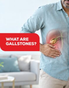 What Are Gallstones?