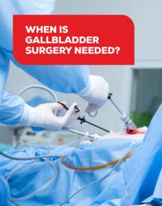When Is Gallbladder Surgery Needed?