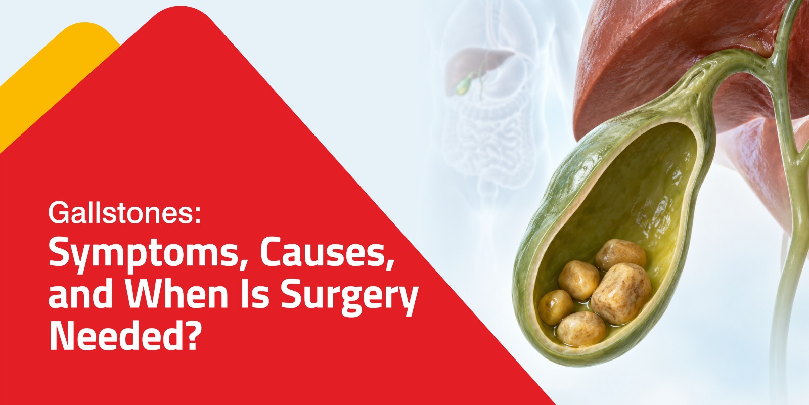Gallstones: Symptoms, Causes, and When Is Surgery Needed?